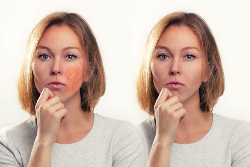 Could Your Flushed Skin Be Rosacea? Experts Highlight The Early Signs And Symptoms